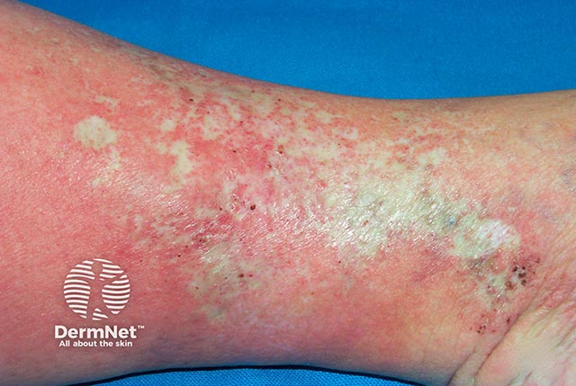 Stellate and reticulate scars resulting in atrophie blanche