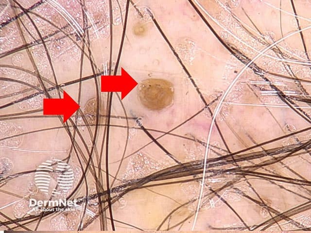 Follicular plugging (red arrows) in discoid lupus erythematosus