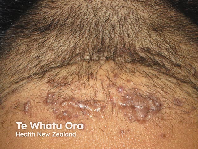 Folliculitis keloidalis nuchae