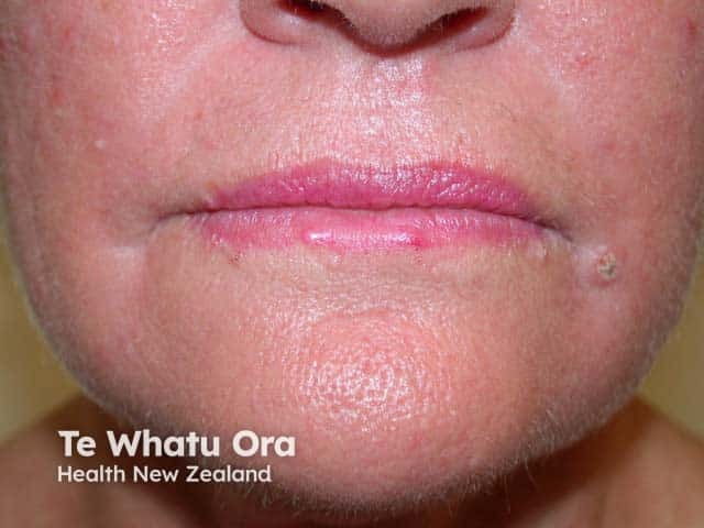 Domed, centrally plugged papules on the face in generalised eruptive keratoacanthomas