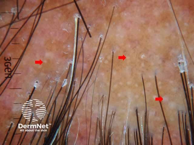 Irregularly distributed follicular openings (red arrows) denoting scarring (cicatricial) alopecia