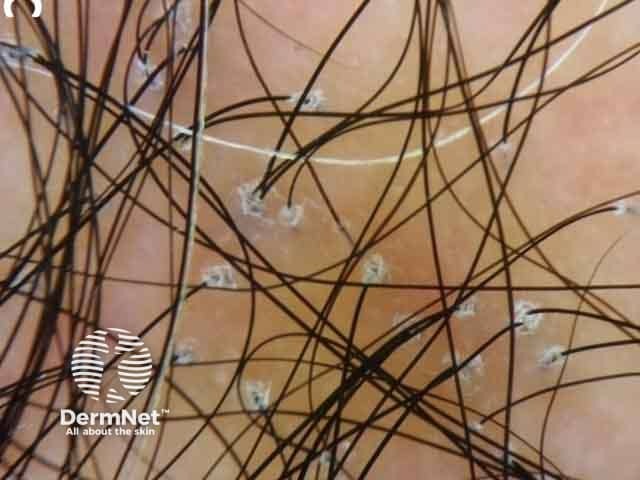 Scaly scalp showing perifollicular scales in a female patient with lichen planopilaris