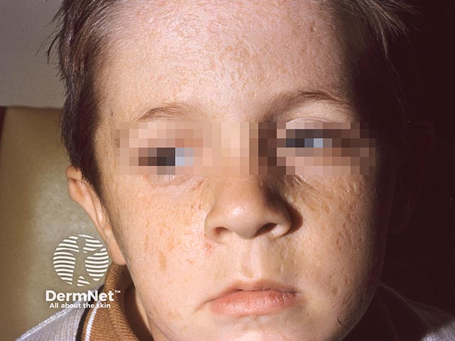 Pock-like scarring