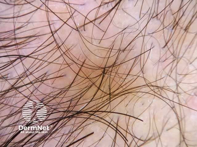 Hair shaft diameter variability in androgenetic alopecia