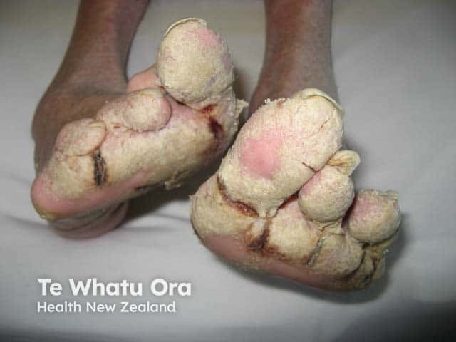 Hyperkeratosis and fissuring on the feet in advanced crusted scabies