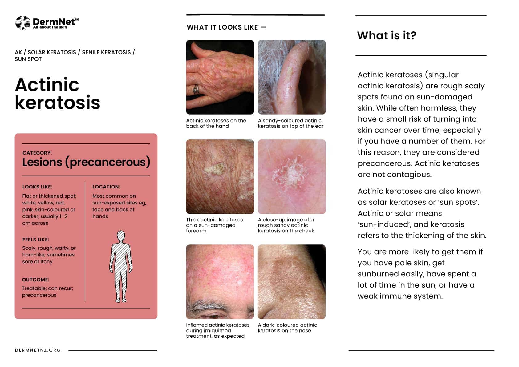 Actinic keratosis