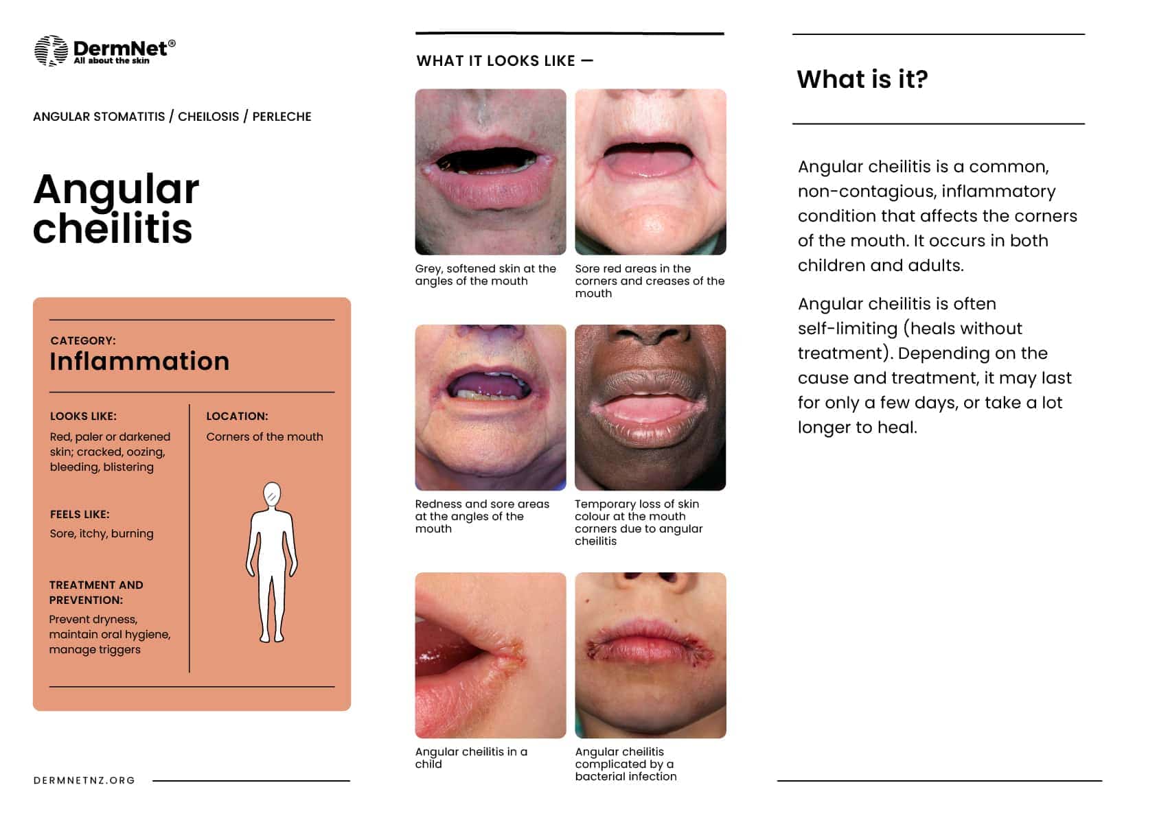 Angular cheilitis
