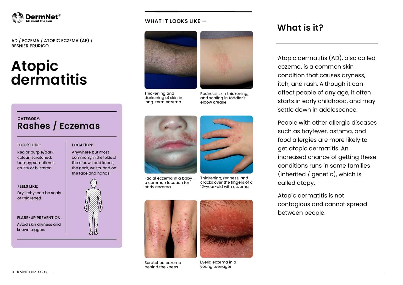 Atopic dermatitis