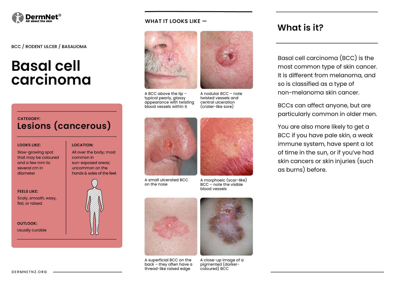 Basal cell carcinoma