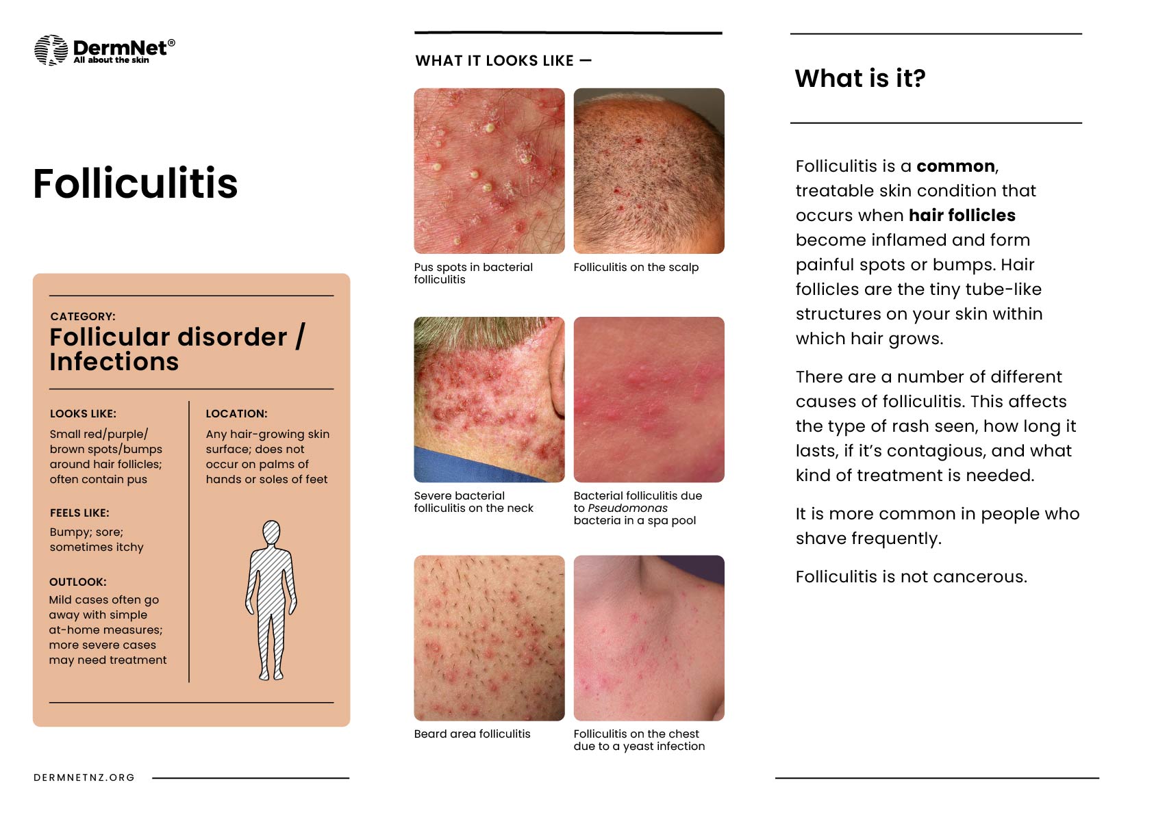 Folliculitis