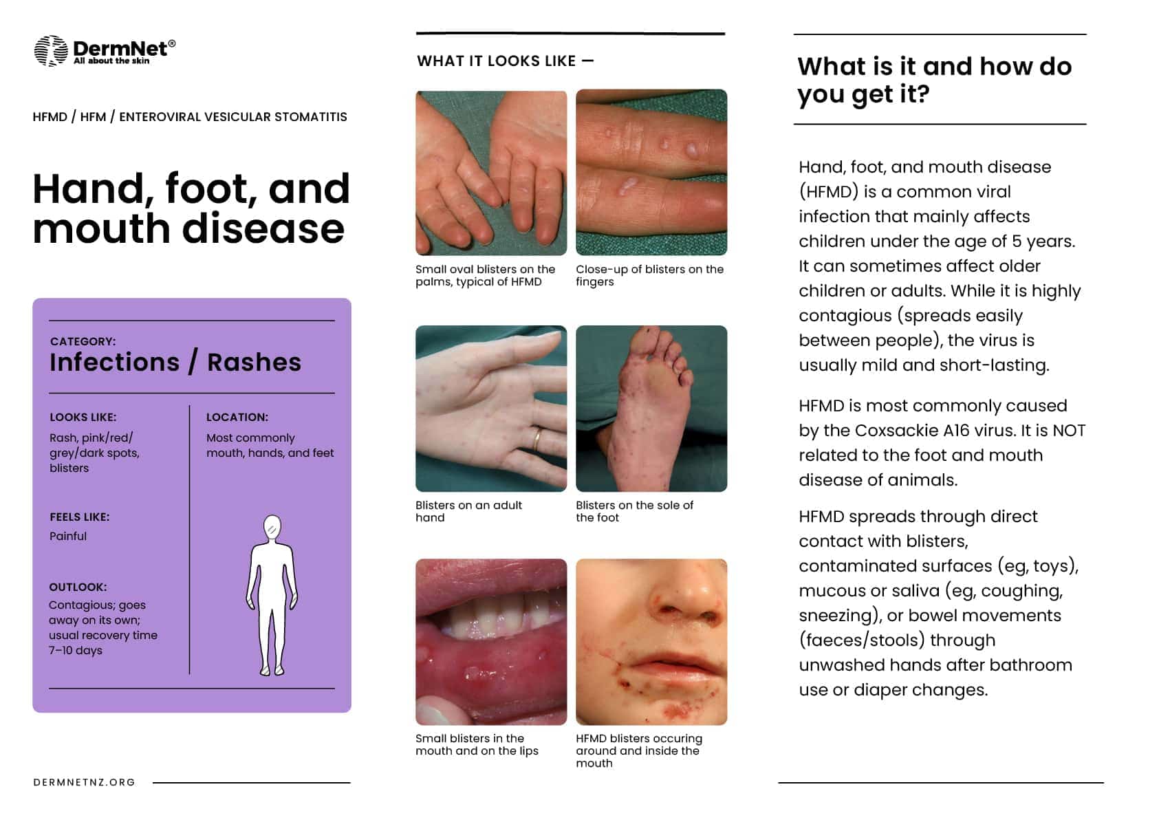 Hand foot and mouth