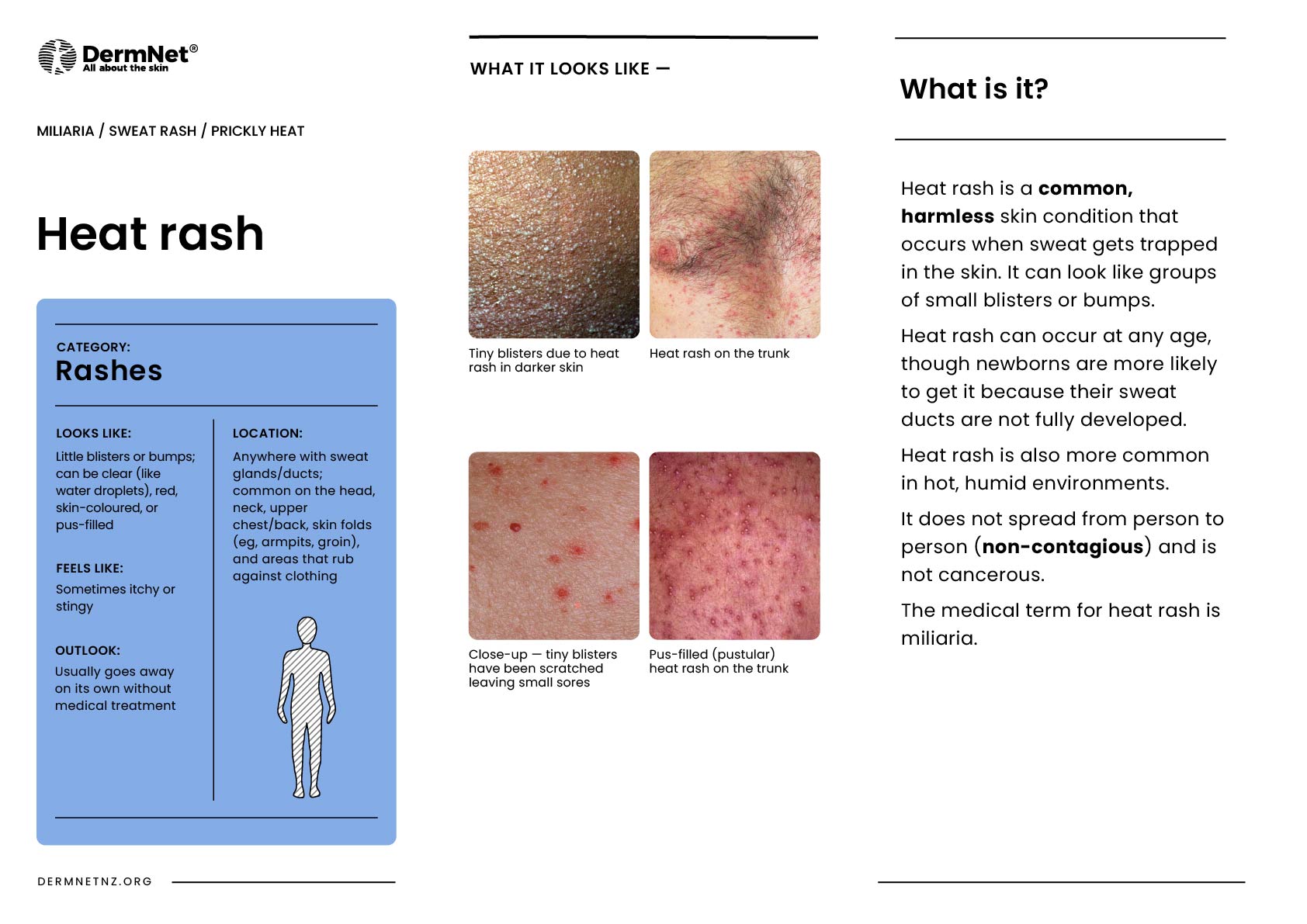 Heat rash