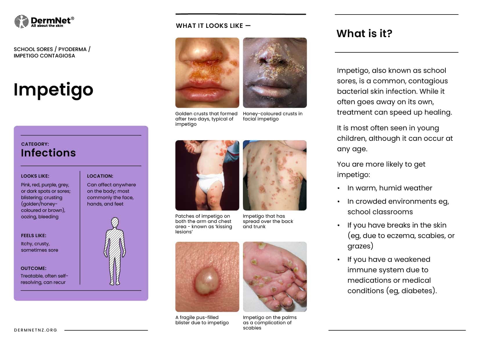 Impetigo
