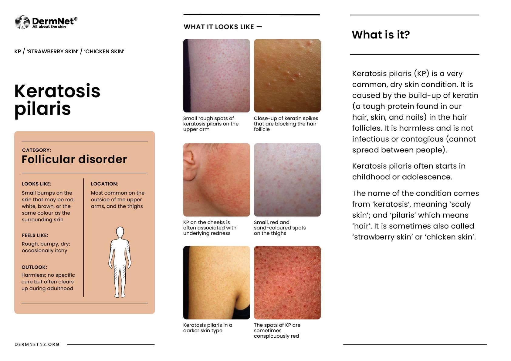 Keratosis pilaris