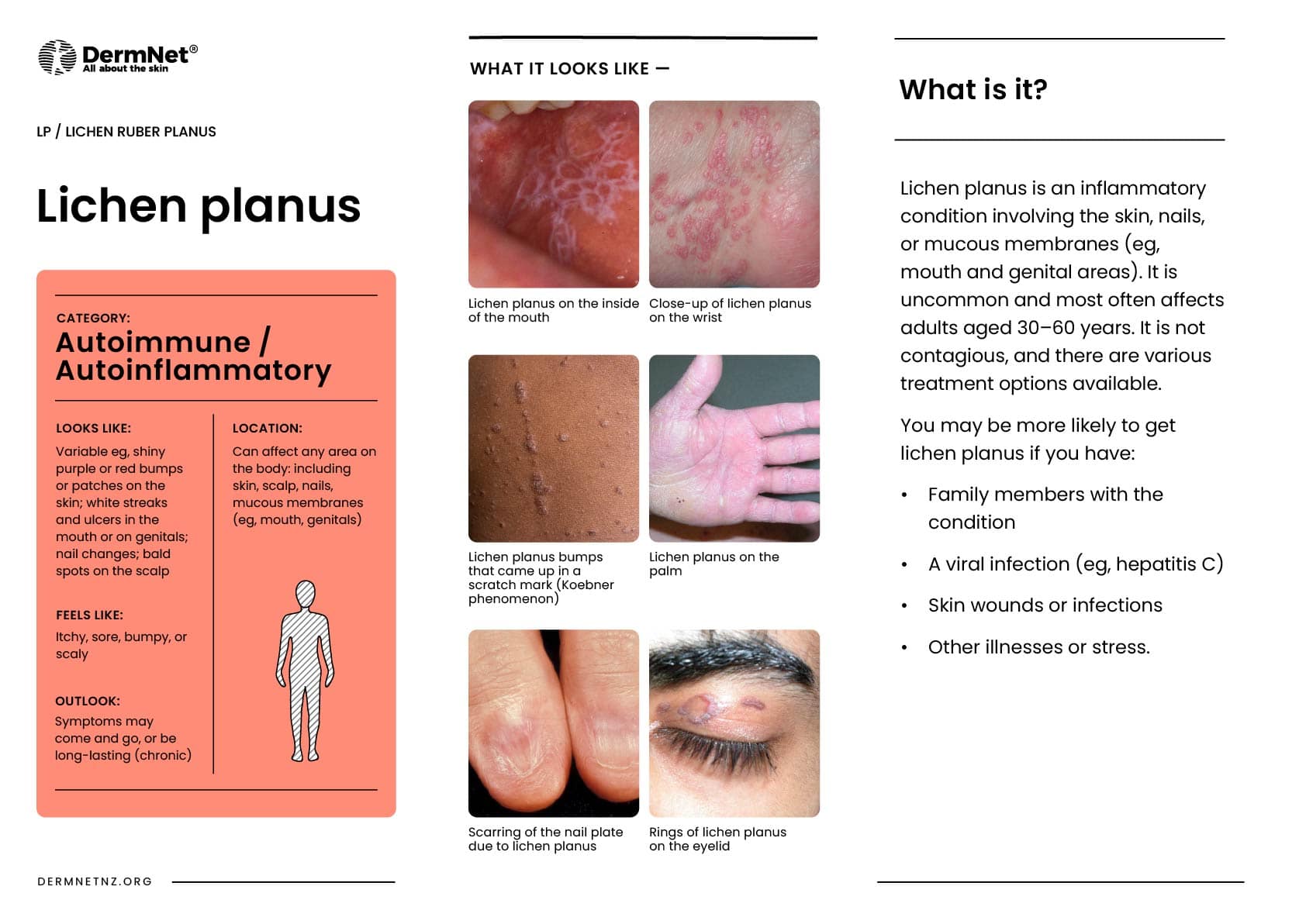 Lichen planus