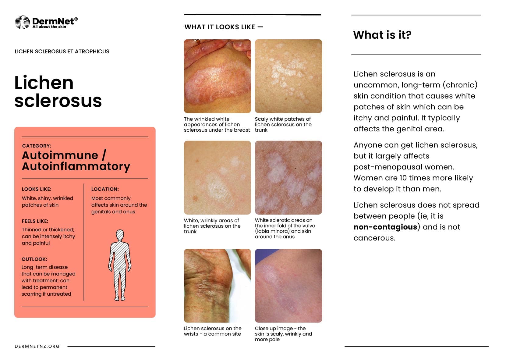 Lichen sclerosus