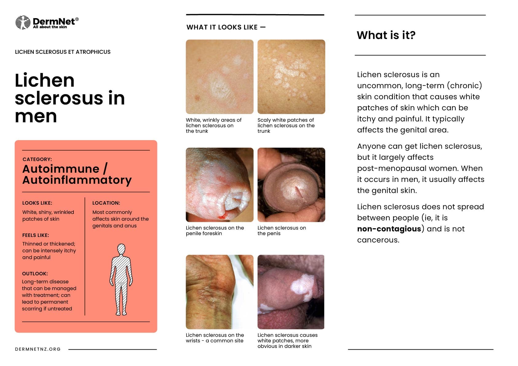 Lichen sclerosus - male
