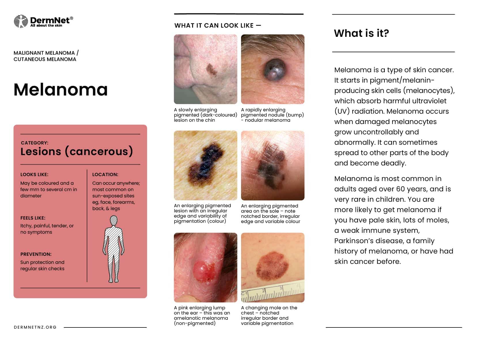 Melanoma