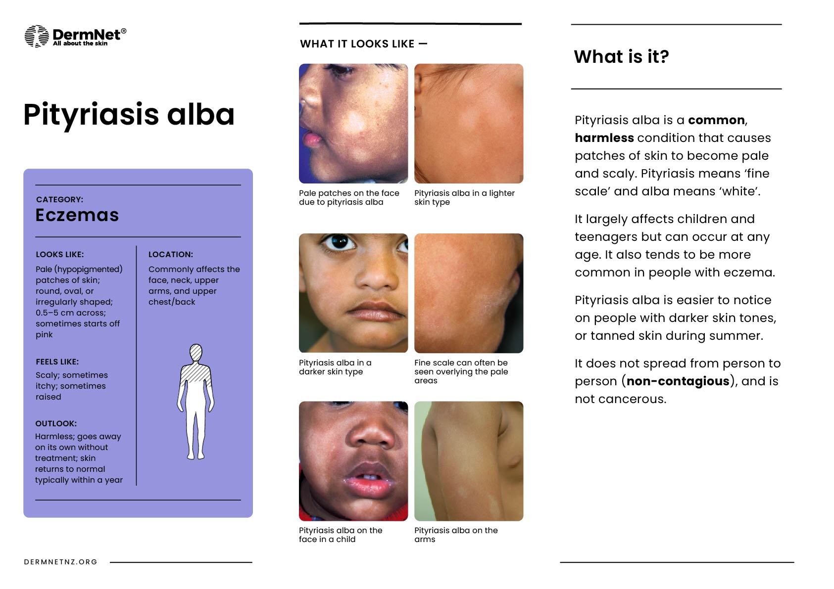 Pityriasis alba