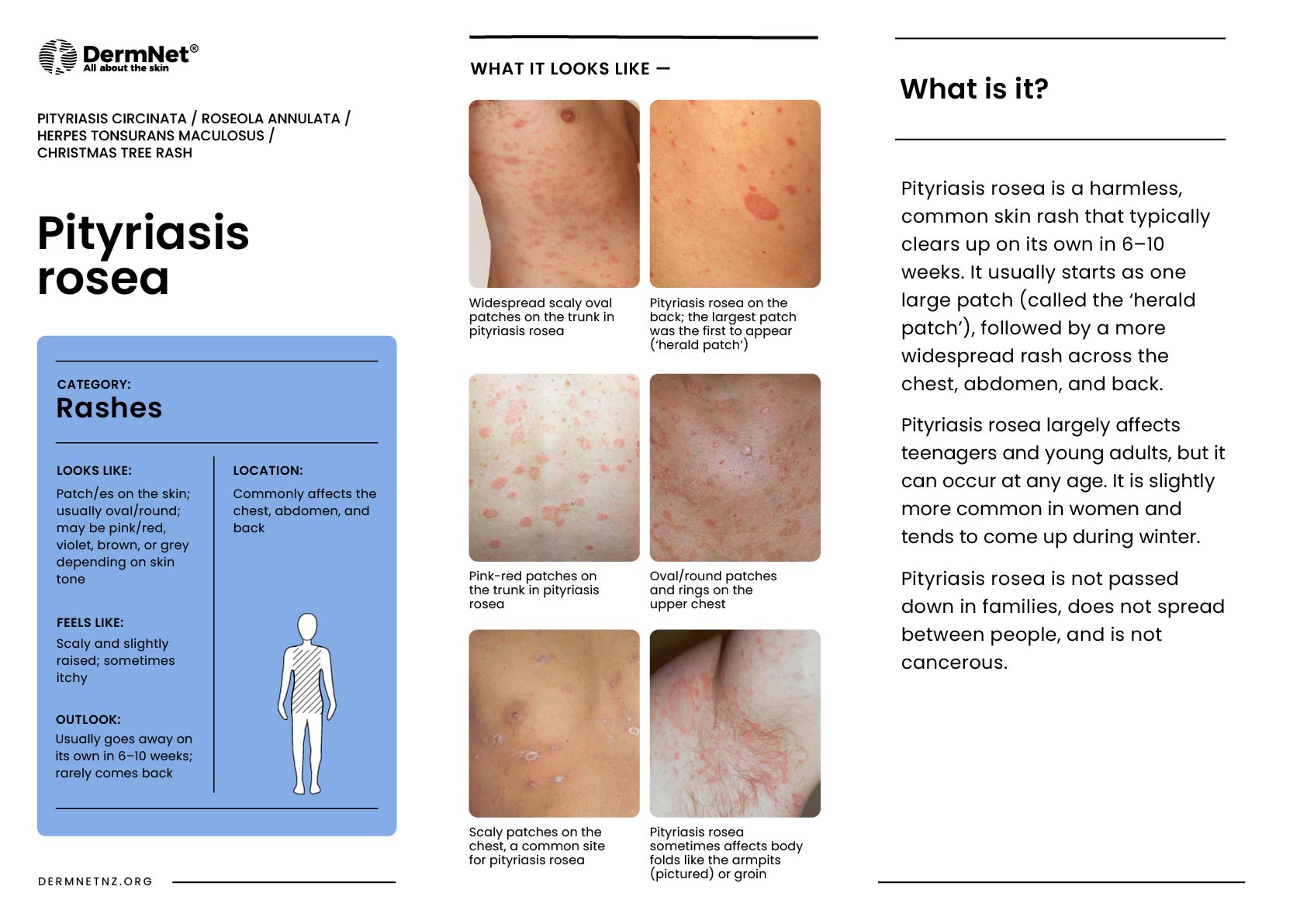 Pityriasis rosea