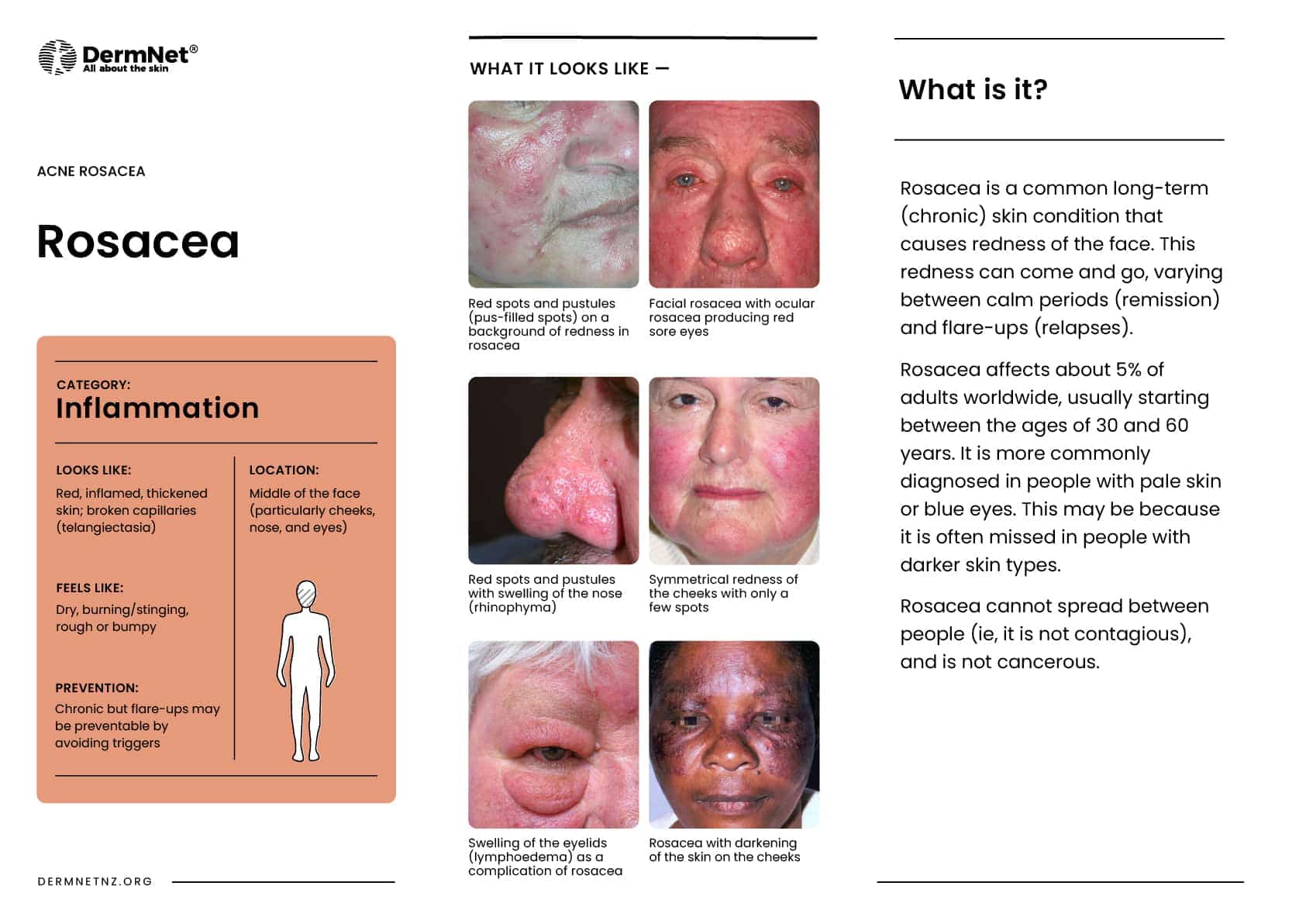 Rosacea