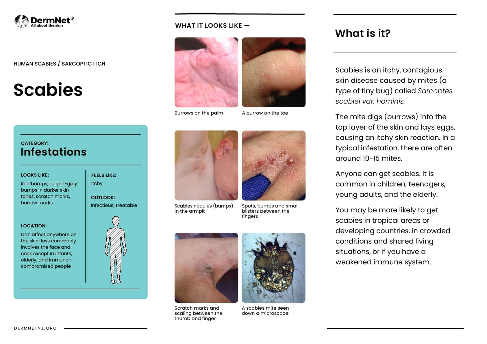 Scabies