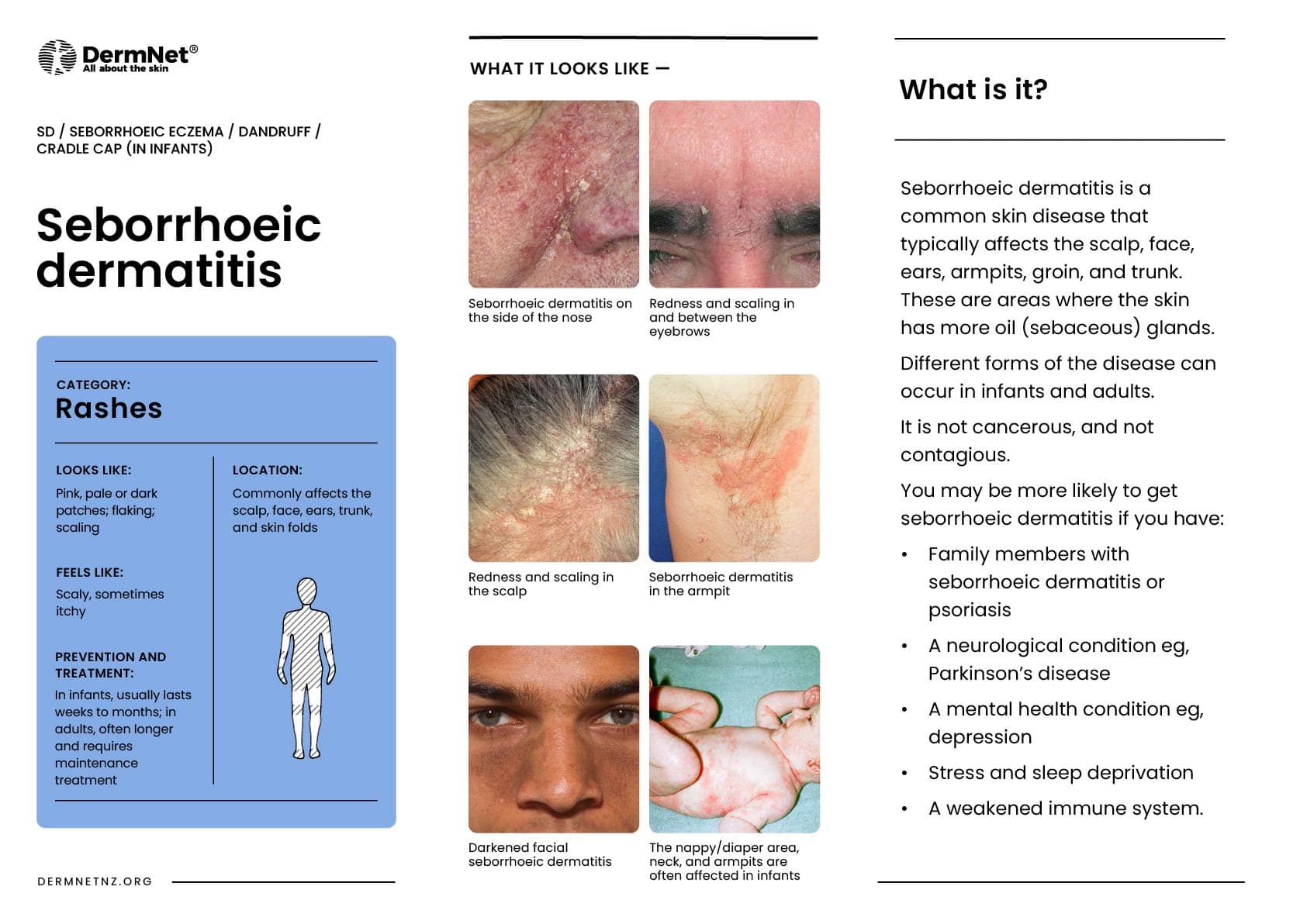 Seborrhoeic dermatitis