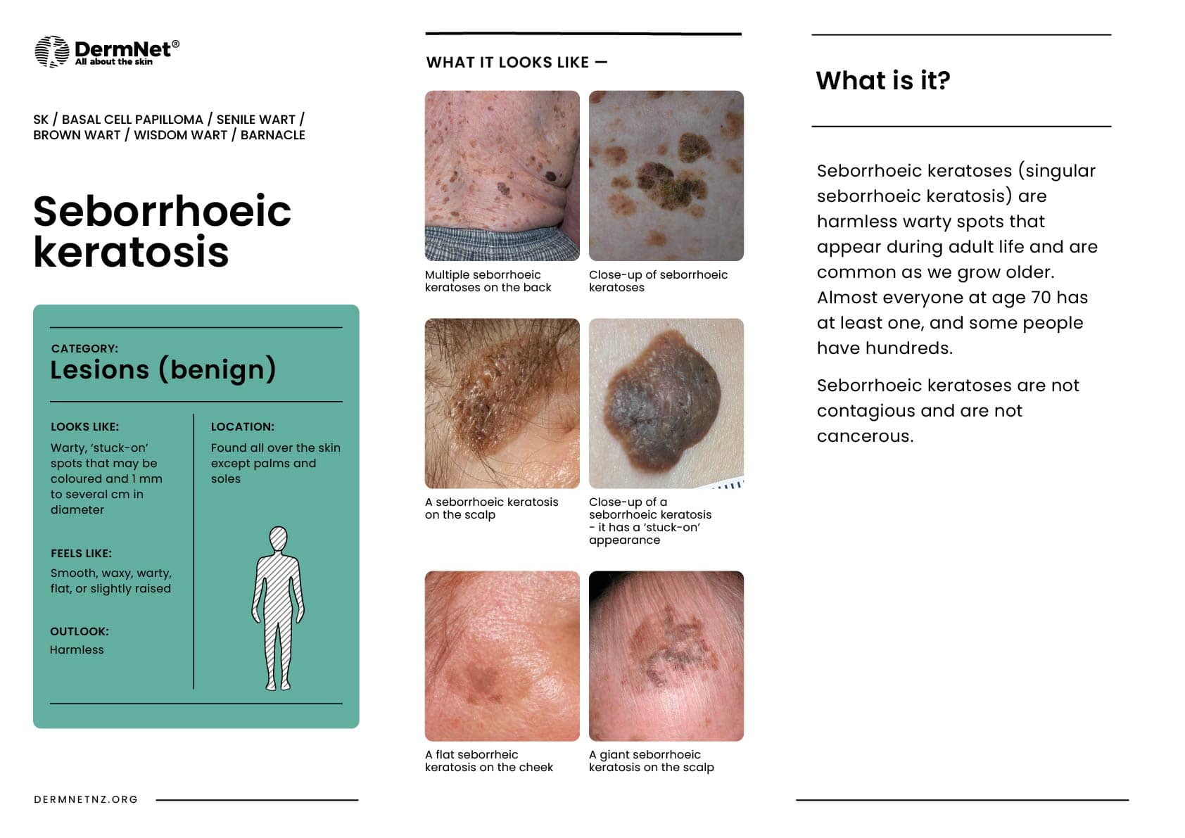 Seborrhoeic keratosis
