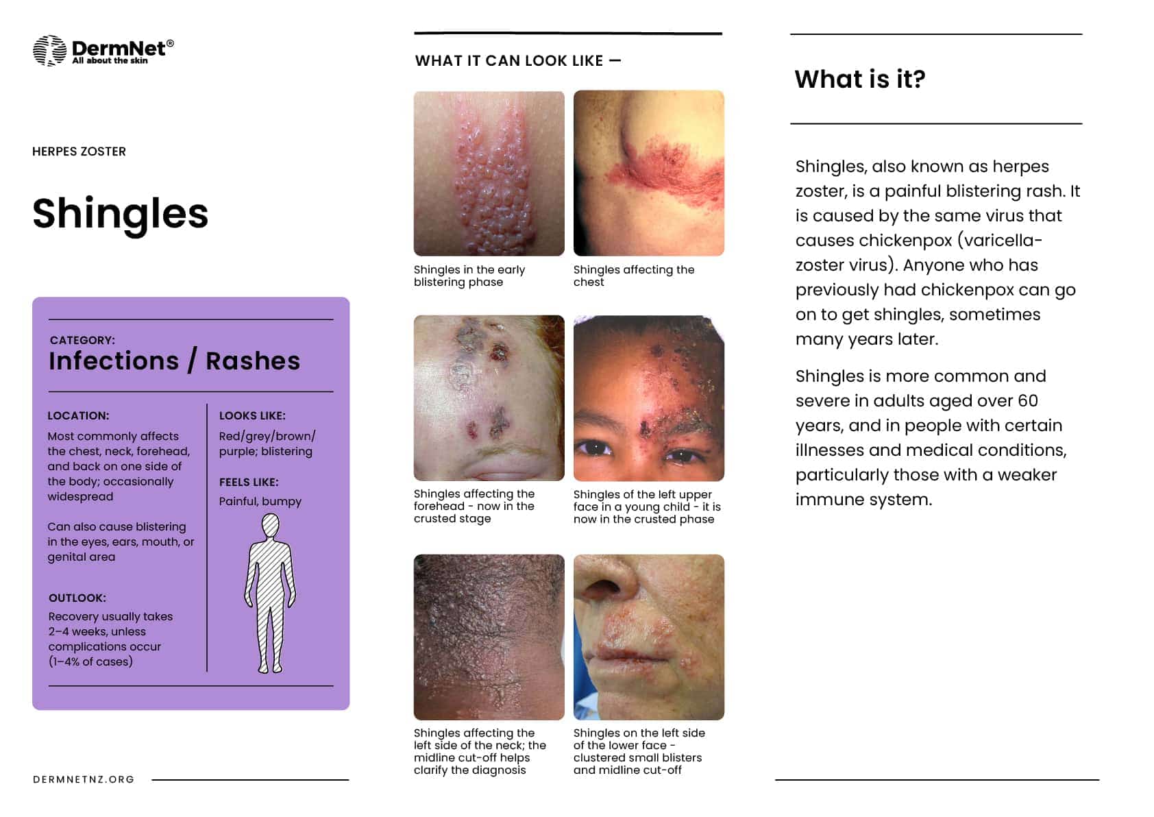 Shingles