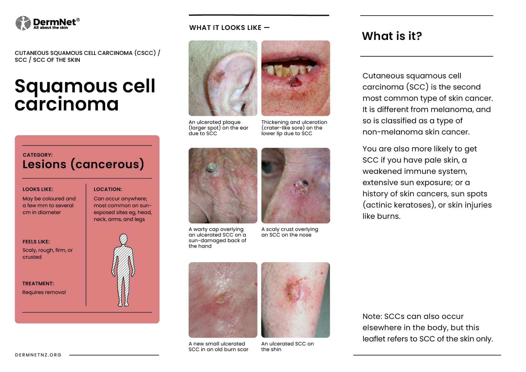 Squamous cell carcinoma