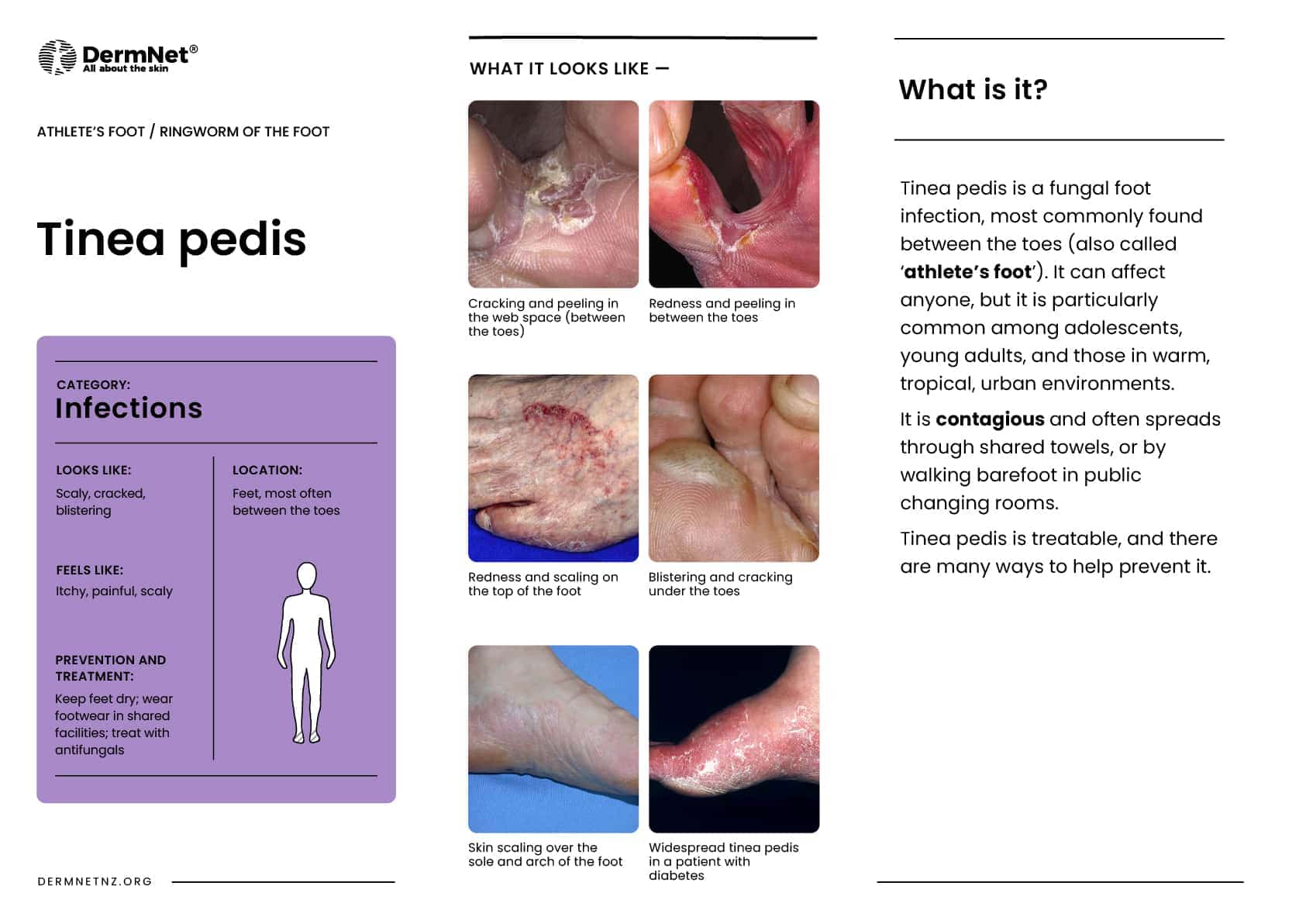 Tinea pedis