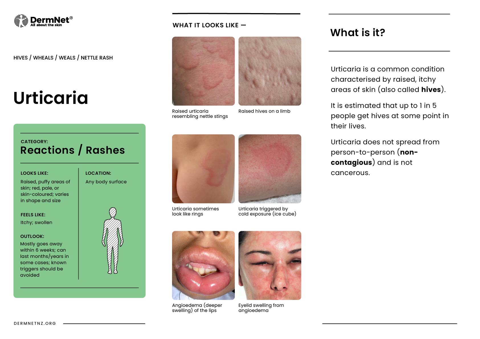 Urticaria